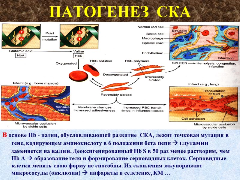 ПАТОГЕНЕЗ  СКА В основе Hb - патии, обусловливающей развитие  СКА, лежит точковая